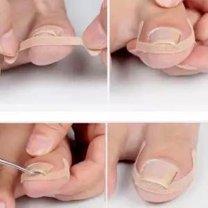 교정 프로 내향성 (12개입세트테이프 발톱 교정 파고드는 내성발톱 밴드