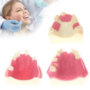 치아 손실 모형 임플란트 학생 교육 훈련 보조 상악 리프트 복원 실험실