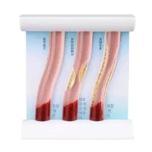 혈관모형 인체 해부학 동적 시뮬레이션 고지혈증 교육용 정교한