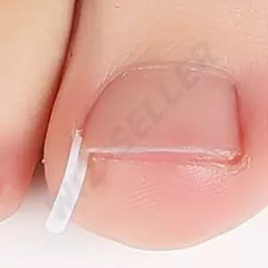 내성발톱 셀프치료 관리교정기 교정팁 보호기 고정스틱