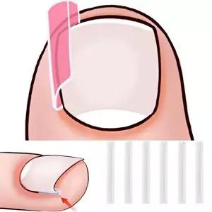 고품질 말린발톱 보호 지지대 내향성발톱 발톱와이어 스틱 발톱테이프 테이핑 발톱테이프 발톱밴드 WFOLYT