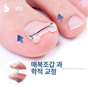클립 와이어 내성발톱 파고드는