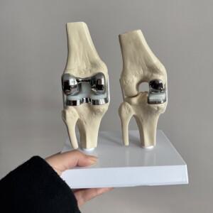 분리형 인공 무릎 보철물 모델 소형 이중 실버 관절 임플란트 세트
