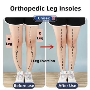 발용 실리콘 정형 안창 O/X 다리 유형 Valgus Varus 교정 발바닥 근막염 젤 깔창 자석 마사지 풋 케어