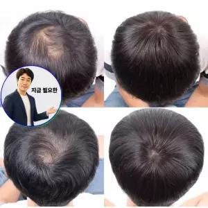 지금 필요한 정수리 커버 O형 남자 부분 인모 가발