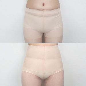 STK113 복부압박스타킹 압박스타킹 보정스타킹