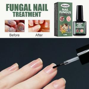 DTC Nail pair ent F Fungus Ca With Fi t val On Foot T Anti omy Nail Liquid is