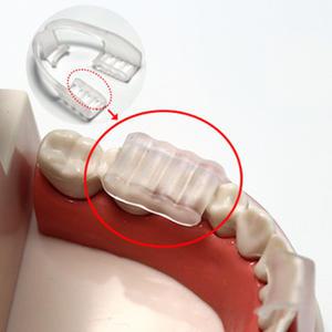 치아보호기 이갈이방지장치 가드 이갈이용 마우스피스