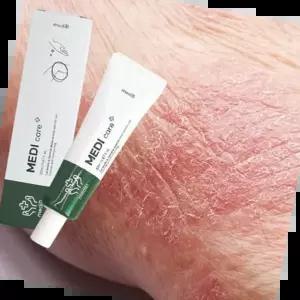 습진연고 건성 피부 진정 크림 건선 가려움증 진물 습진 연고