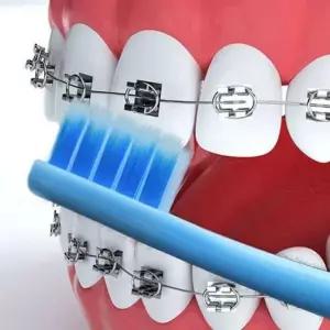 V컷 교정칫솔 개별포장 틈새교정기 어금니 교정용치솔