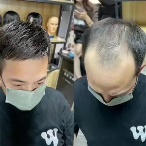 남성 정수리가발 블랙 헤어패치 부분 탈모 커버 맞춤 남성가발 H725