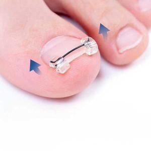 와이어 파고드는 셀프 자가 발톱 클립 내성발톱 가정용