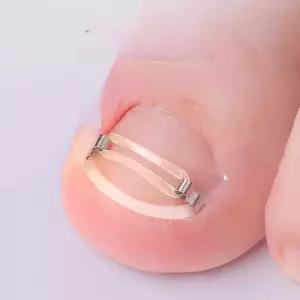 내성발톱교정기 발톱교정기 엄지발톱 내성손톱