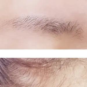 속눈썹길어지는영양제 속눈섭영양제 남자 헤어라인교정 속눈썹생장술