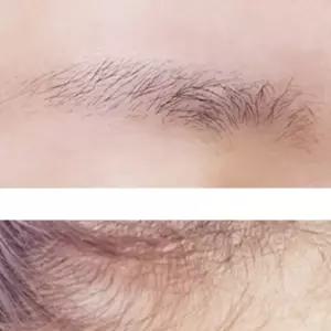 속눈썹길어지는영양제 속눈섭영양제 남자 헤어라인교정 속눈썹생장술