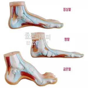 -발모형 세트 정상발 평발 굽은발 326